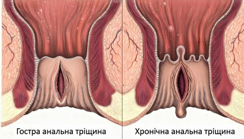Анальна тріщина: симптоми, причини, види, лікування (03)