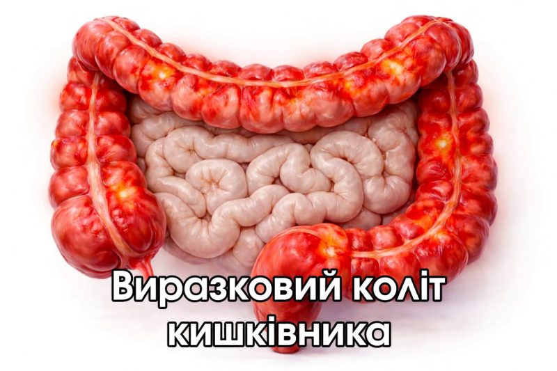 Виразковий коліт кишківника: симптоми, причини, діагностика, сучасне лікування (02)