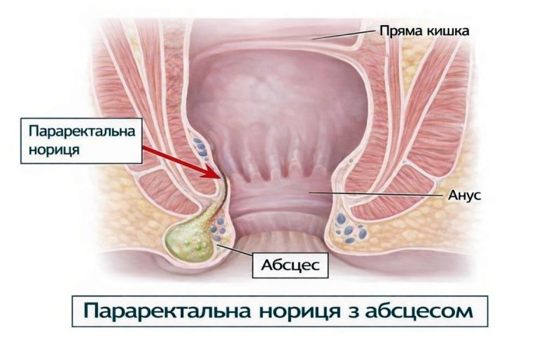 Параректальна нориця: симптоми, причини, класифікація та сучасні методи лікування (02)