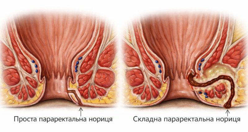 Параректальна нориця: симптоми, причини, класифікація та сучасні методи лікування (04)